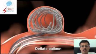 Balloon Assisted Coiling of Brain Aneurysm Hindi [upl. by Hsetih]