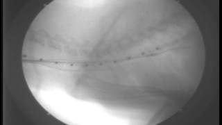 Primary Tracheal Collapse9DAY1090Stent deployment under fluoroscopy [upl. by Orton]