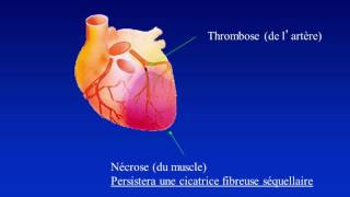 5 à 7 Dépister et prévenir linsuffisance cardiaque [upl. by Mcafee976]