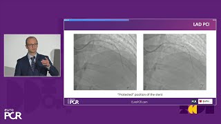 Cracking open the discussion on the clinical experience with intravascular lithotripsy in ACS [upl. by Vasilis]