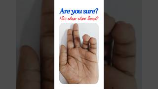 How to be sure of ulnar claw hand Partial claw hand Guyon’s canal syndrome shorts [upl. by Oos]