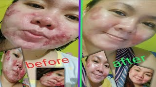 Using TRETINOIN  BENZOYL PEROXIDE in 30days ll Skin care routine for acne prone [upl. by Aelam]