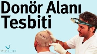 Donör Alanı Tespiti  Saç Ekimi Uzmanı  İbrahim Çevik [upl. by Ardnalac167]