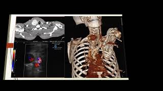 Hepatic artery pseudoaneurysim [upl. by Francine]