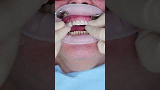 Dental veneers in Prague shorts dentist dental veneers short [upl. by Nysila753]