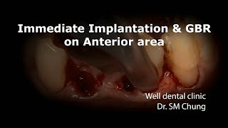 Immediate implantation amp GBR on Anterior area Bone Level [upl. by Ahsekan]