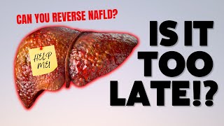 NAFLD How to Treat and Reverse NonAlcoholic Fatty Liver Disease [upl. by Munmro]