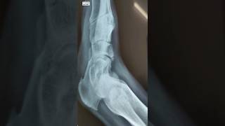 Navicular bone chip fracture viral youtubeshort trending ayurveda [upl. by Jessamine]