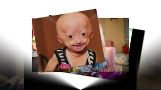 Youtuber Adalia Rose Texas star dies at 15 from rare medical condition [upl. by Aniakudo597]