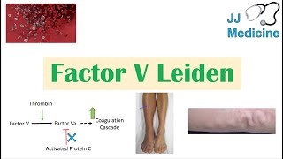 Factor V Leiden  Causes Pathophysiology Symptoms Diagnosis Treatment [upl. by Constant]