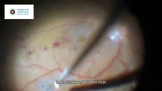 Diabetic Vitrectomy  ILM peeling  Epiretinal Membrane  Dr Ashish K Jain  MEHRC Mumbai [upl. by Savil787]