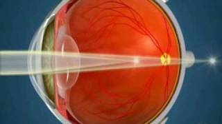 How Orthokeratology Works [upl. by Ennaihs]