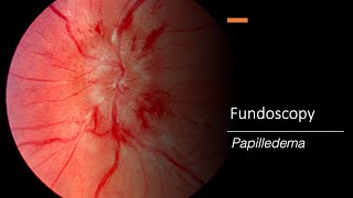 Papilledema Fundoscopy [upl. by Drazze]