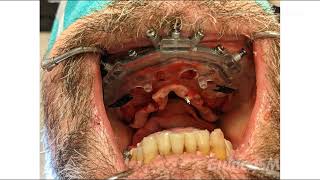 GuidedSMILE Dentate Maxilla Nobel FP3  Dr Fried [upl. by Aowda]