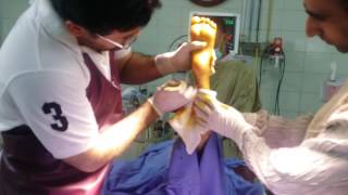 Percutaneous Achilles tenotomy procedure2 [upl. by Willing777]