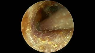 耳掃除】左だけイヤホンの音が聞こえにくくて～ earwax recommended by my wife 58 [upl. by Dnar]