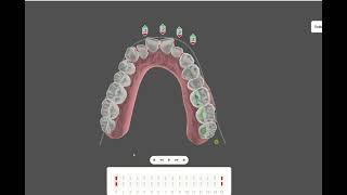 EXPANSION DentalMeshAIArchForm [upl. by Manno]