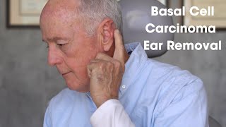 Basal Cell Carcinoma Ear Removal Patient Testimonial Part 1 [upl. by Elyrehc]