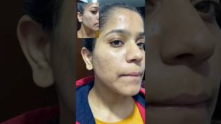 Tretinoin before and after 9month complete tretinoin face acne darkspots pimpleproblem [upl. by Yared14]