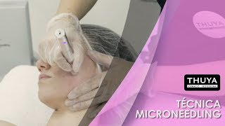 MESOESTETIC TÉCNICA MICRONEEDLING [upl. by Yadnil299]