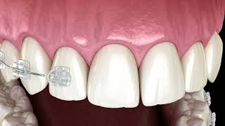 Aparat dentar safir  Un aparat dentar invizibil elgant discret si eficient la pret rezonabil [upl. by Jovita20]