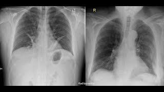 Hemothorax pneumothorax pleural effusion [upl. by Anreval]