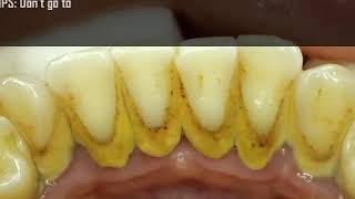 Ultimate Teeth Cleaning Treatment  Easy Tips for a Brighter Smile [upl. by Rosio]