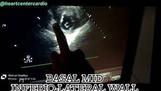 SEVERE CHEST PAIN WITH SWEATING ECG Acute inferioposterior wall MI [upl. by Asiul199]