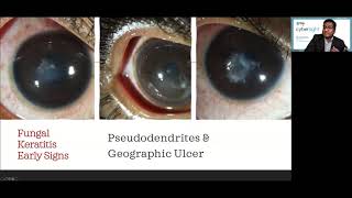 Lecture Microbial Keratitis Update for General Ophthalmologists [upl. by Buyers369]