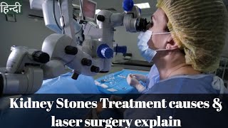 Kidney Stones Treatment causes and laser surgery explain in hindi [upl. by Siegel]