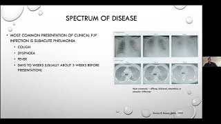 Pneumocystis jirovecii pneumonia  Current Issues in its Management [upl. by Odlavso]