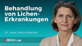 LichenErkrankungen Ist die Behandlung mit Cortisonsalbe genug  Dr med Petra Wiechel  QS24 [upl. by Voltmer]