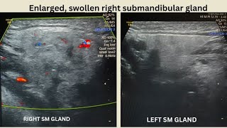 Ludwigs Angina Ultrasound [upl. by Sherlocke]