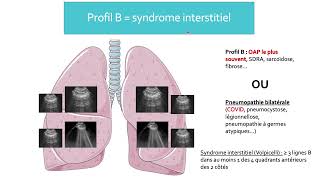 3 Pneumopathies syndromes interstitiels et pleurésie [upl. by Glenn]