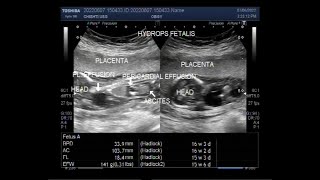 Hydrops fetalis with Fetal ascites pleural effusion pericardial effusion and Soft tissue edema [upl. by Dnilazor]