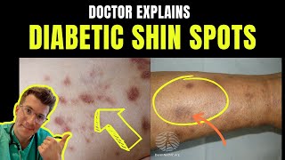 Doctor explains DIABETIC DERMOPATHY AKA DIABETIC SHIN SPOTS – plus causes and prevention [upl. by Osswald156]