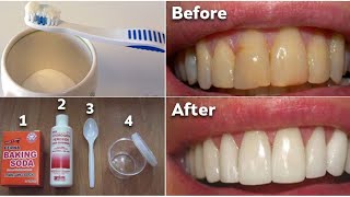 Teeth whitening home remedies overnight [upl. by Trula666]