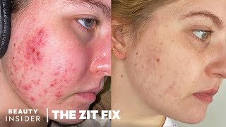 My 8Month Accutane Journey Side Effects And Results  The Zit Fix [upl. by Heyde996]