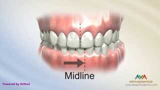 Orthodontic Treatment for Narrow Upper Jaw with Functional Shift  Expander or Spacer [upl. by Ehr]