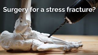 Stress Fracture Surgery What You Need to Know [upl. by Adnilasor]