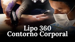 LIPO 360 CONTORNO CORPORAL  Cirurgia do Dia  Dr Samuel Orige [upl. by Myer152]