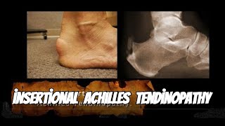 Why Achilles Tendinopathy Happens and How to Fix It [upl. by Namie]