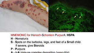 HenochSchonlein Purpura HSP Mnemonic [upl. by Mill463]