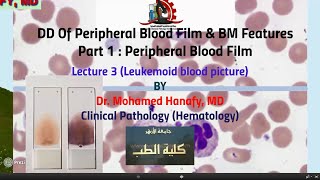 Part1  Peripheral Blood Film Lecture 3 Leukemoid blood picture [upl. by Drolet]