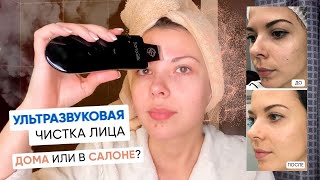 Ультразвуковая чистка лица дома или в салоне [upl. by Ahsemrak]