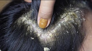 dandruff removal huge flakes scratching on head7 [upl. by Kaylee]