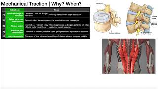 Mechanical Traction Part 1  Theory Indications amp Contraindications [upl. by Yecak456]