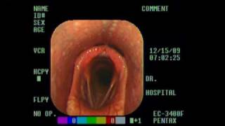 Normal Larynx mpg [upl. by Merilyn452]