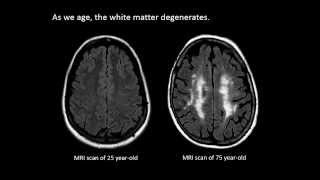 The Aging Brain  Week by Week Time Lapse [upl. by Ayaros]