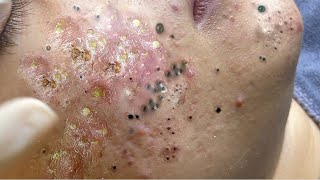 Big Cystic Acne Blackheads Extraction Blackheads amp Milia Whiteheads Removal Pimple Popping  65766 [upl. by Vyse837]